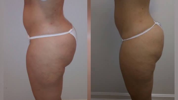 Before and after 2 Posh Body Slim Body Contouring Sessions - Treatment Goal Fat Reduction & Skin Tightening