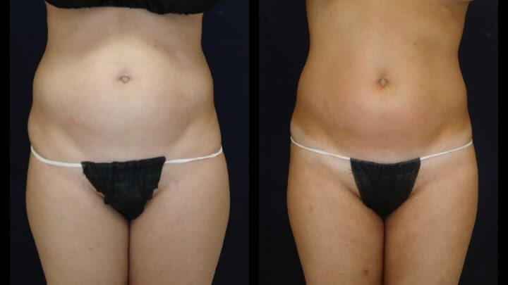 Before and after 3 Posh Body Slim Body Contouring Sessions - Treatment Goal Fat Reduction & Skin Tightening