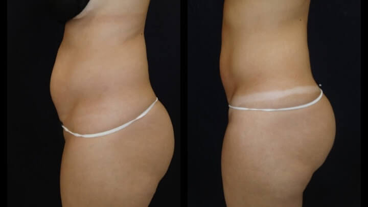 Before and after 3 Posh Body Slim Body Contouring Sessions - Treatment Goal Fat Reduction & Skin Tightening Before and after 3 Posh Body Slim Body Contouring Sessions - Treatment Goal Fat Reduction & Skin Tightening