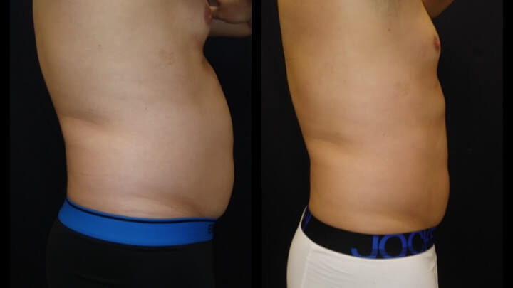 Before and after 2 Posh Body Slim Body Contouring Sessions - Treatment Goal Fat Reduction &