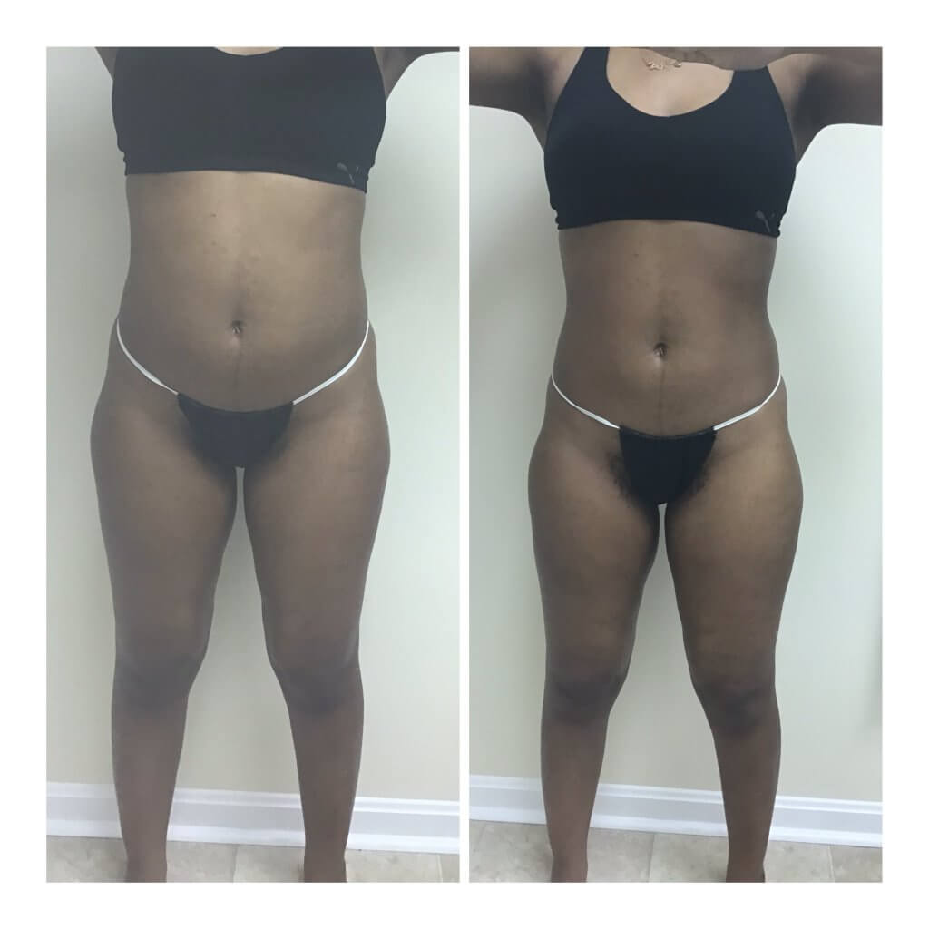 Get Results with the Posh Body Slim Body Sculpting System. Before and after 1 Posh Body Slim Body Contouring Session - Treatment Goal Fat Reduction & Skin Tightening
