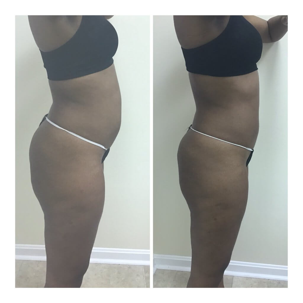 Get Results with the Posh Body Slim Body Sculpting System. Before and after 1 Posh Body Slim Body Contouring Session - Treatment Goal Fat Reduction & Skin Tightening