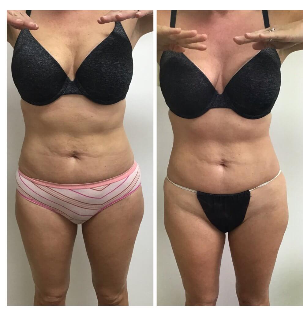 Before and after 1 Posh Body Slim Body Contouring Session - Treatment Goal Fat Reduction &amp; Skin Tightening