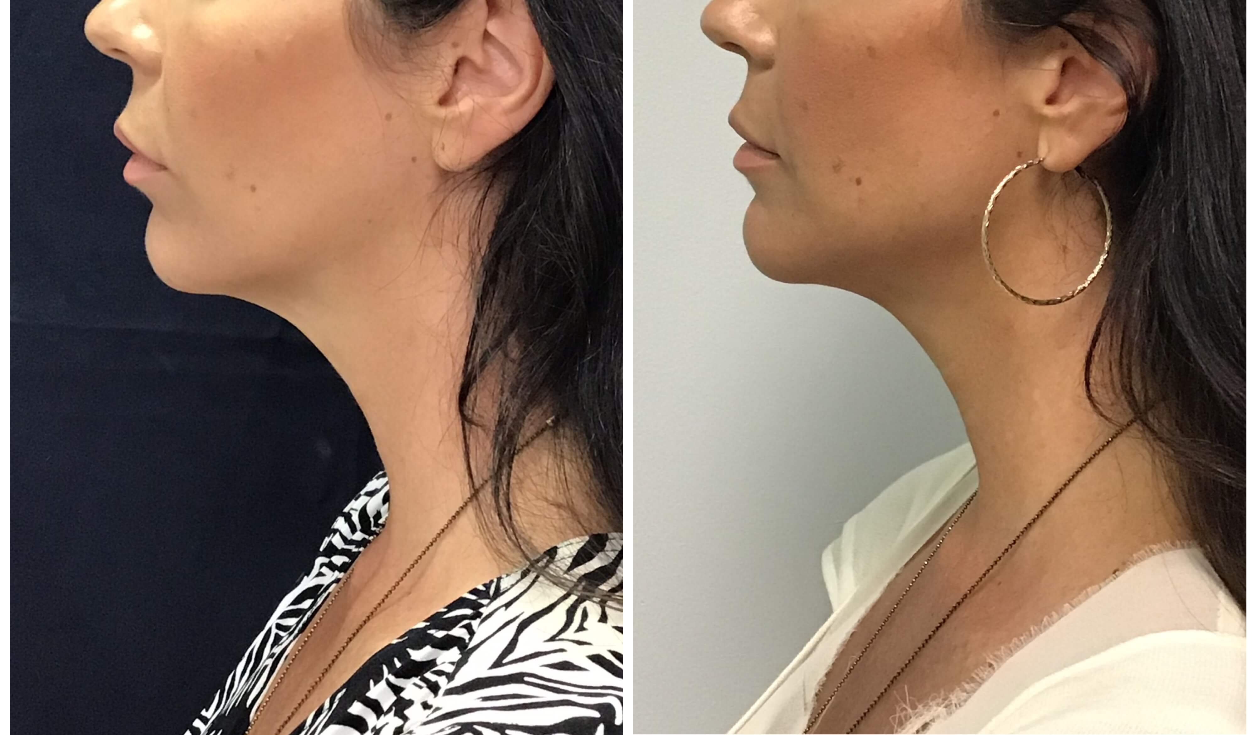 Y Lift ® Nonsurgical Facelift Lunchtime Facelift View Patient Photos