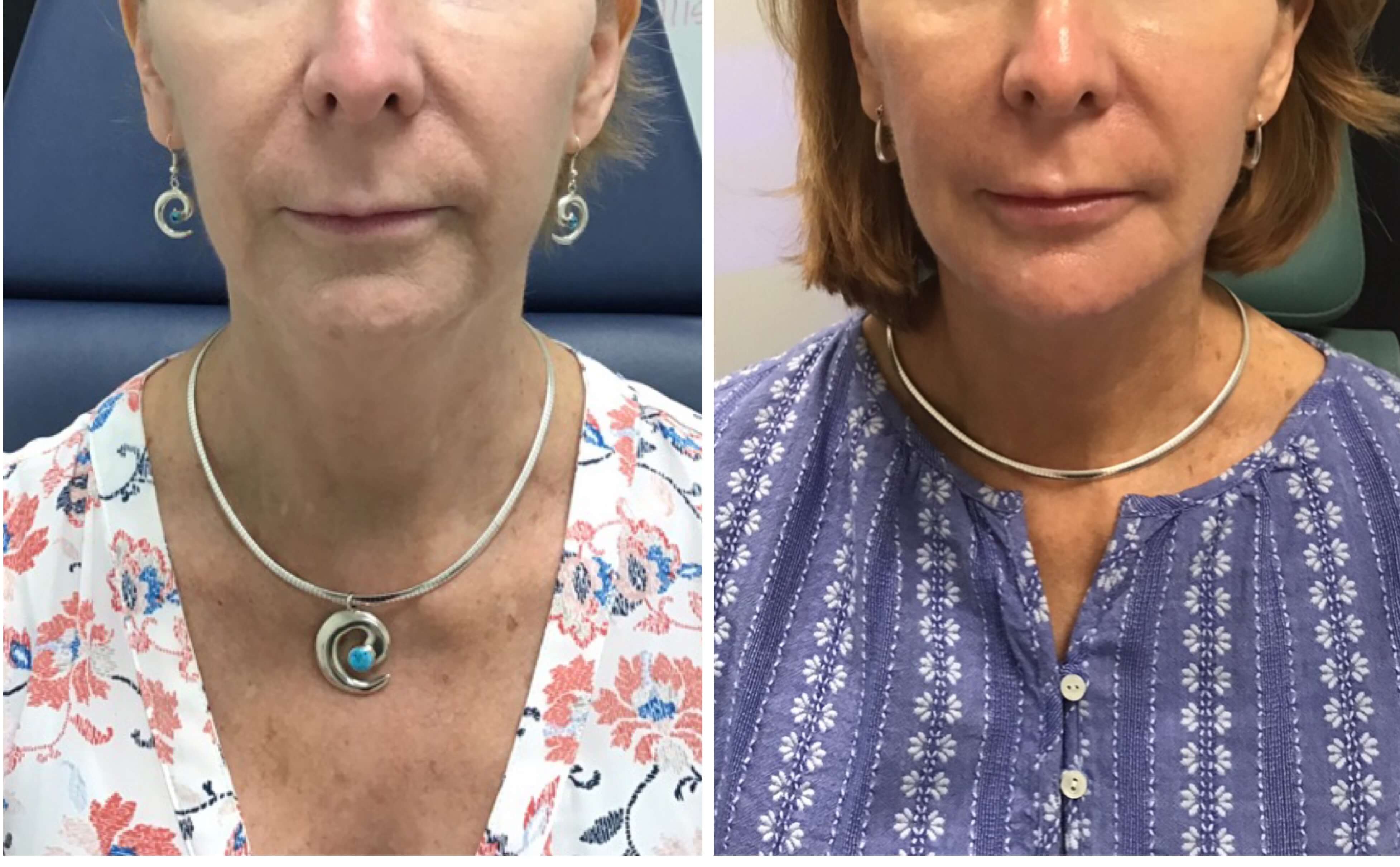 Y Lift® – Nonsurgical Facelift