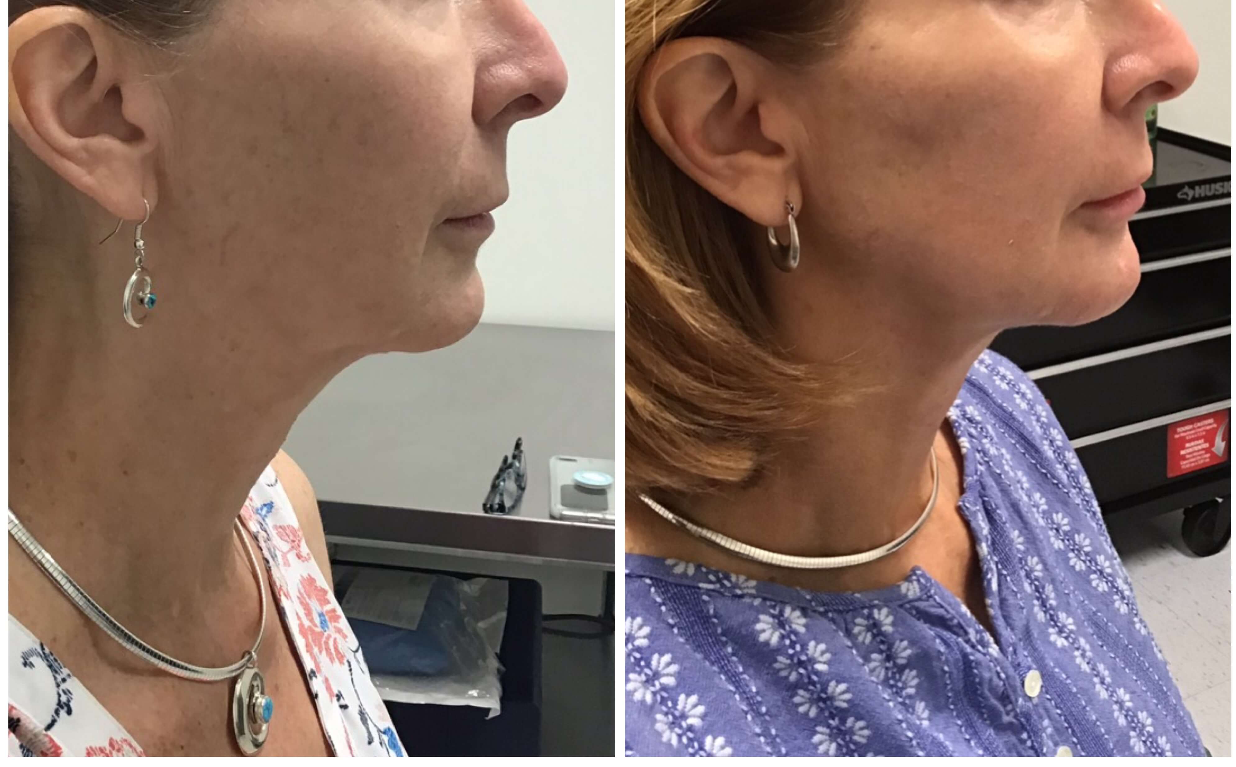 Y Lift ® Nonsurgical Facelift Lunchtime Facelift View Patient Photos