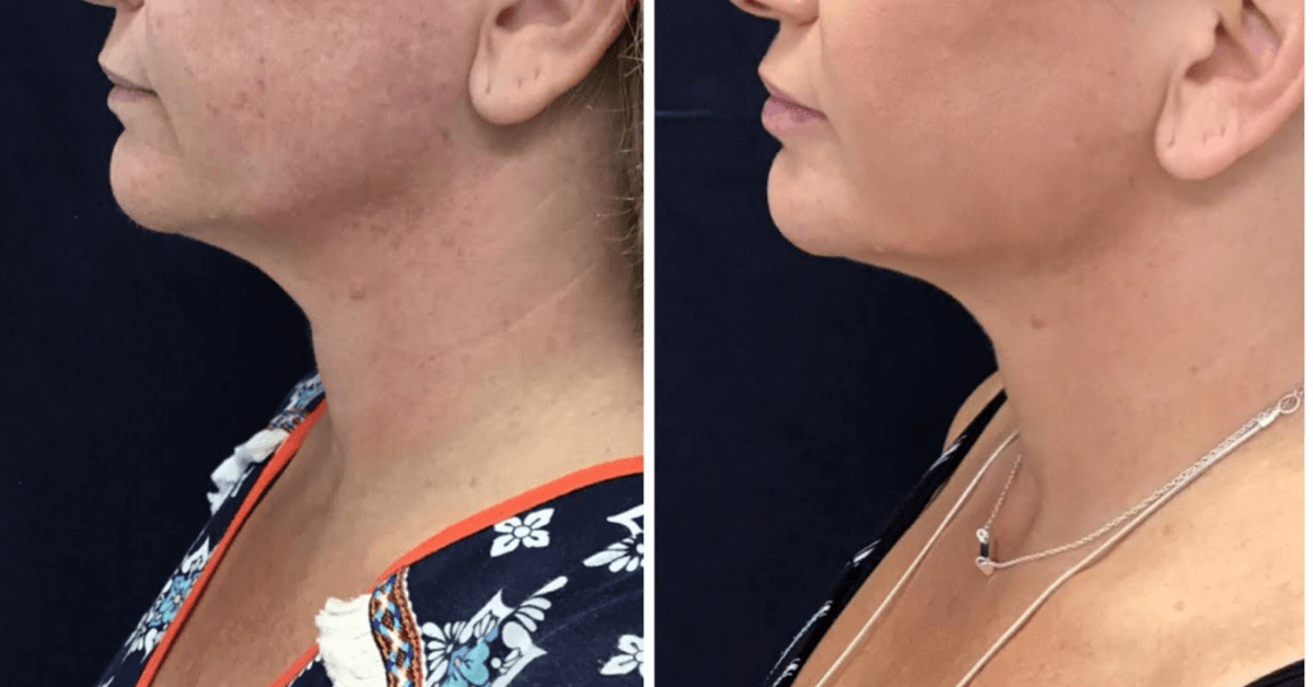 Before and after Y Lift by Dr. Monte Slater