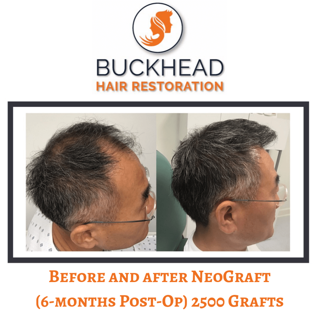 Before and After NeoGraft Hair Restoration