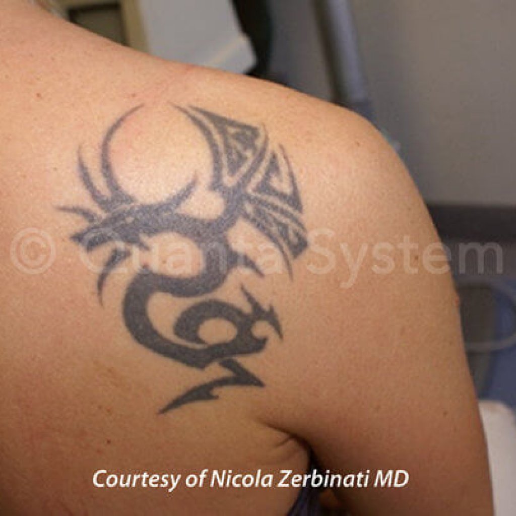 Tattoo Removal Coupon / Tattoo Removal - NYC Tattoo Removal Spa | Groupon : Get a coupon code for laserless tattoo removal with an easy click.