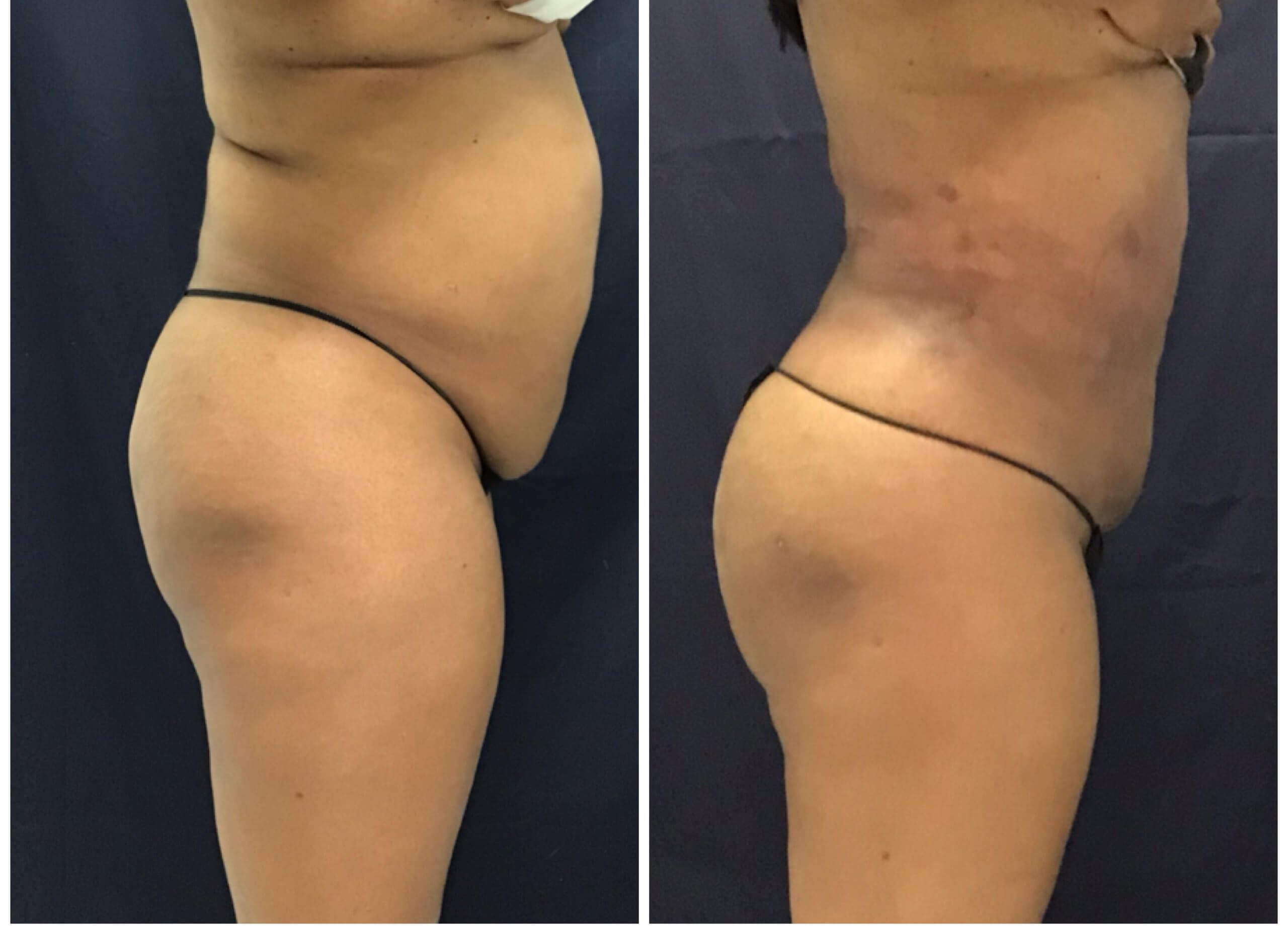 Before and after 6 Weeks PureLipo with ThermiRF for skin tightening and fat transfer to the buttocks (Brazillian Butt Lift) Before and after Brazilian Butt Lift - Liposuction with Thermitight for skin Tightening before and after 6 weeks