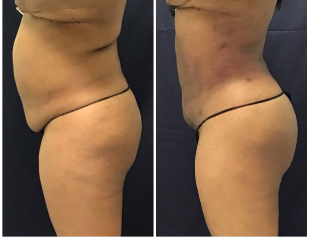 Before and after 6 Weeks PureLipo Liposuction with ThermiRF for skin tightening and fat transfer to the buttocks (Brazillian Butt Lift)