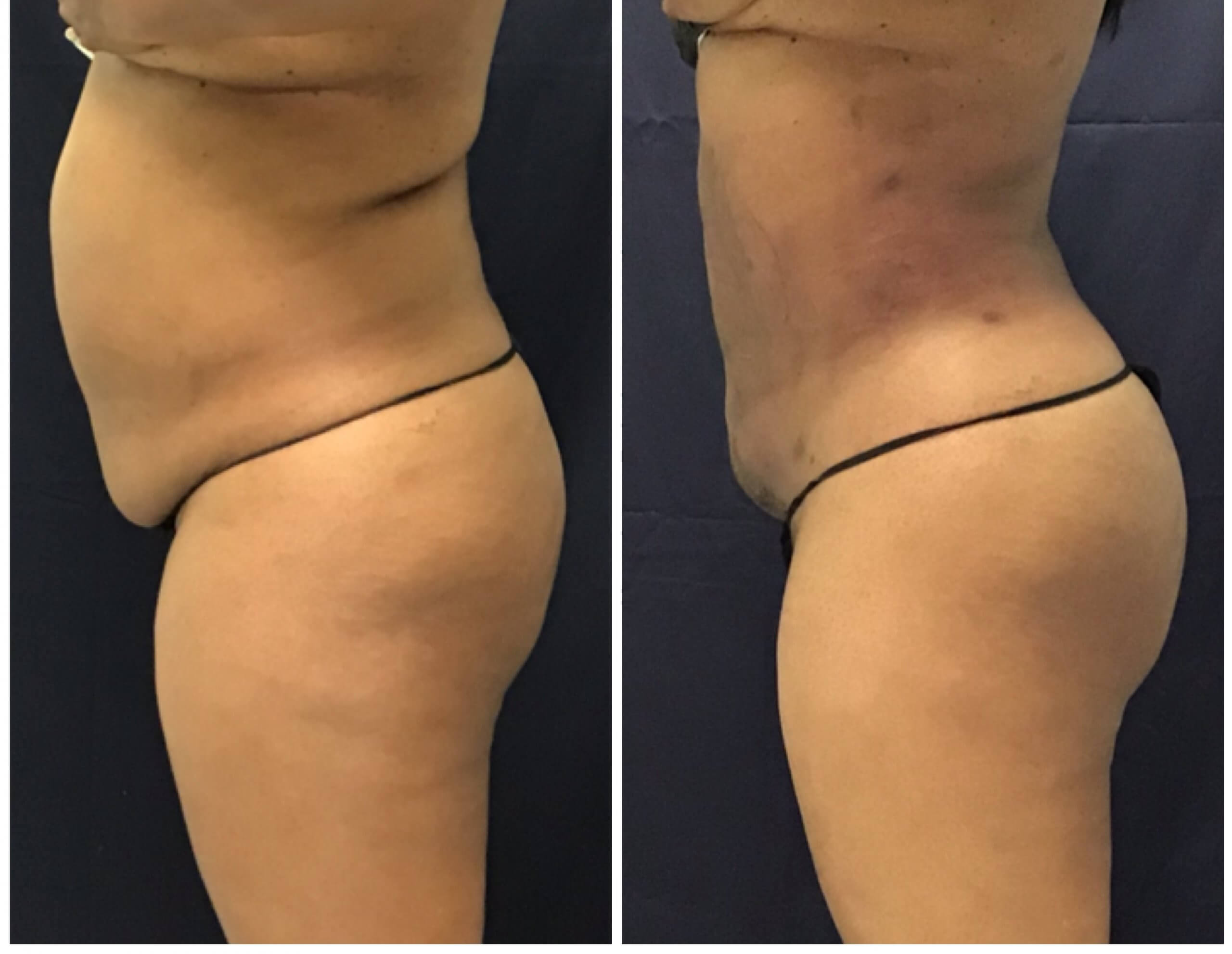 Before and after 6 Weeks PureLipo with ThermiRF for skin tightening and fat transfer to the buttocks (Brazillian Butt Lift) Before and after 6 Weeks PureLipo with ThermiRF for skin tightening and fat transfer to the buttocks (Brazillian Butt Lift)