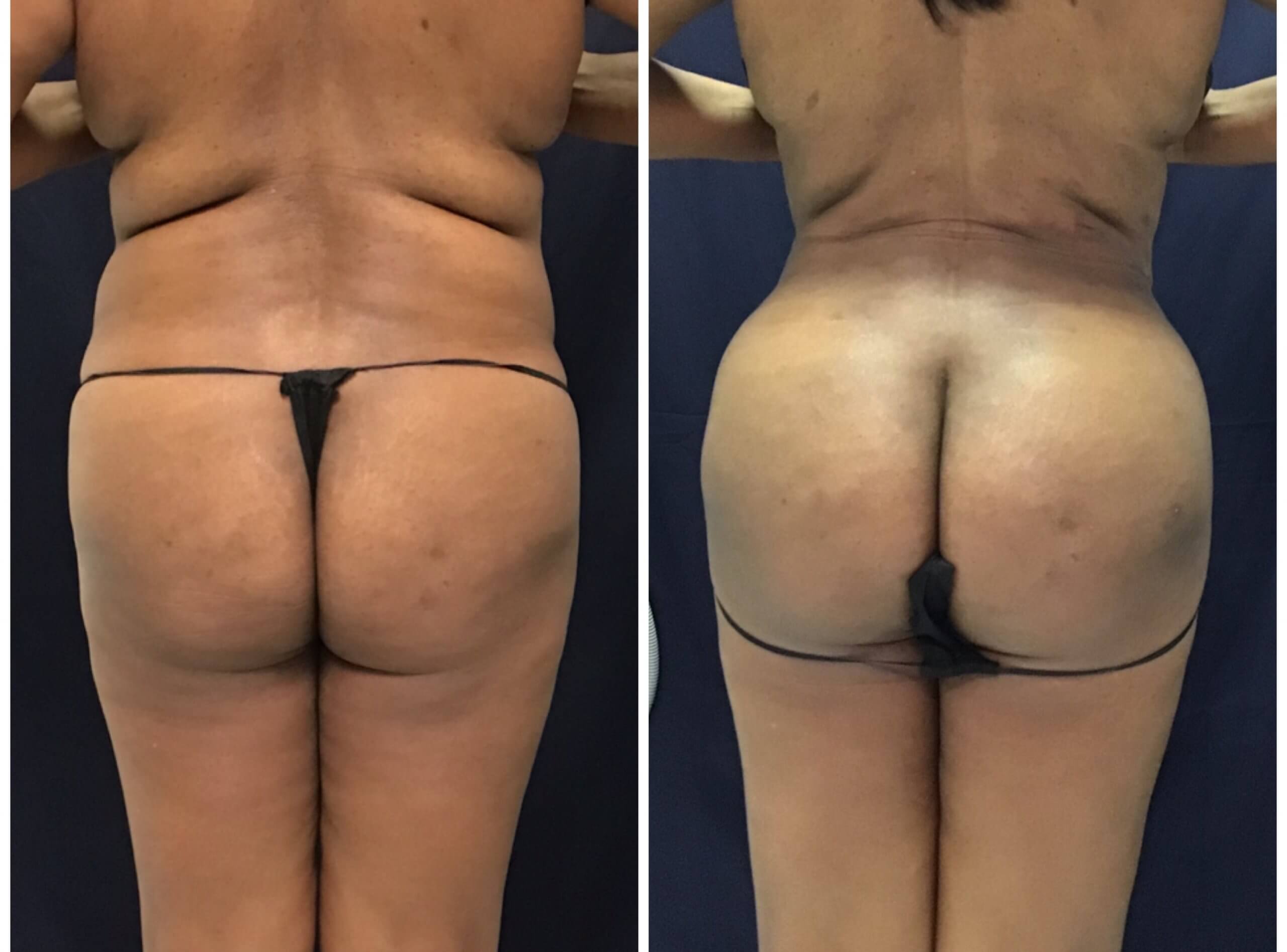 Before and after 6 Weeks PureLipo with ThermiRF for skin tightening and fat transfer to the buttocks (Brazillian Butt Lift) Before and after 6 Weeks PureLipo with ThermiRF for skin tightening and fat transfer to the buttocks (Brazillian Butt Lift)