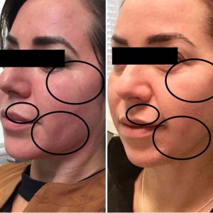 Before and Three Weeks After Receiving the CoolPeel Laser Treatment with Dr. Monte Slater