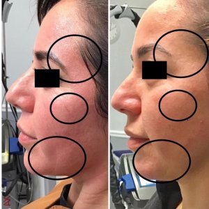 Before and Three Weeks After Receiving the CoolPeel Laser Treatment with Dr. Monte Slater