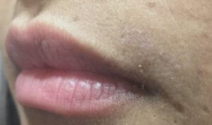  After hair removal with Motus AX for hair around lips 