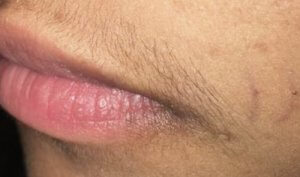 before the treatment of hair around the lips 