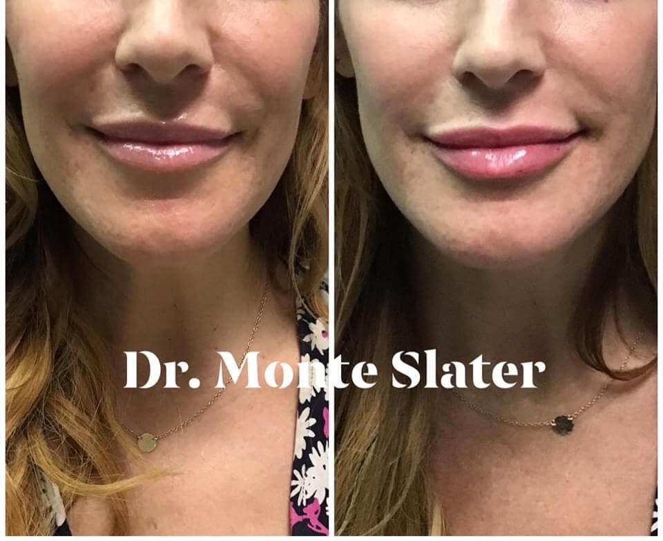 Before and After Kysse Lip fil.er with Dr. Monte Slater in Atlanta Georgia 