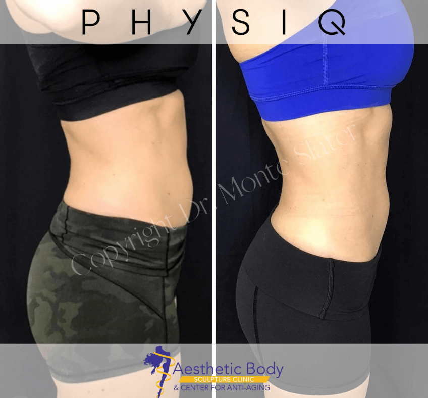 What is Physiq™ Body Sculpting? — Lea Henderson Aesthetics