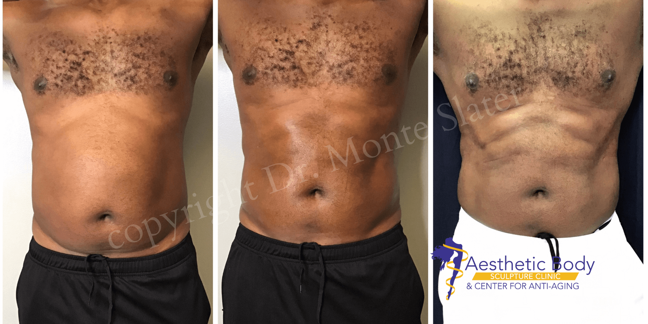 Exclusive Before & After Physiq Body Treatments