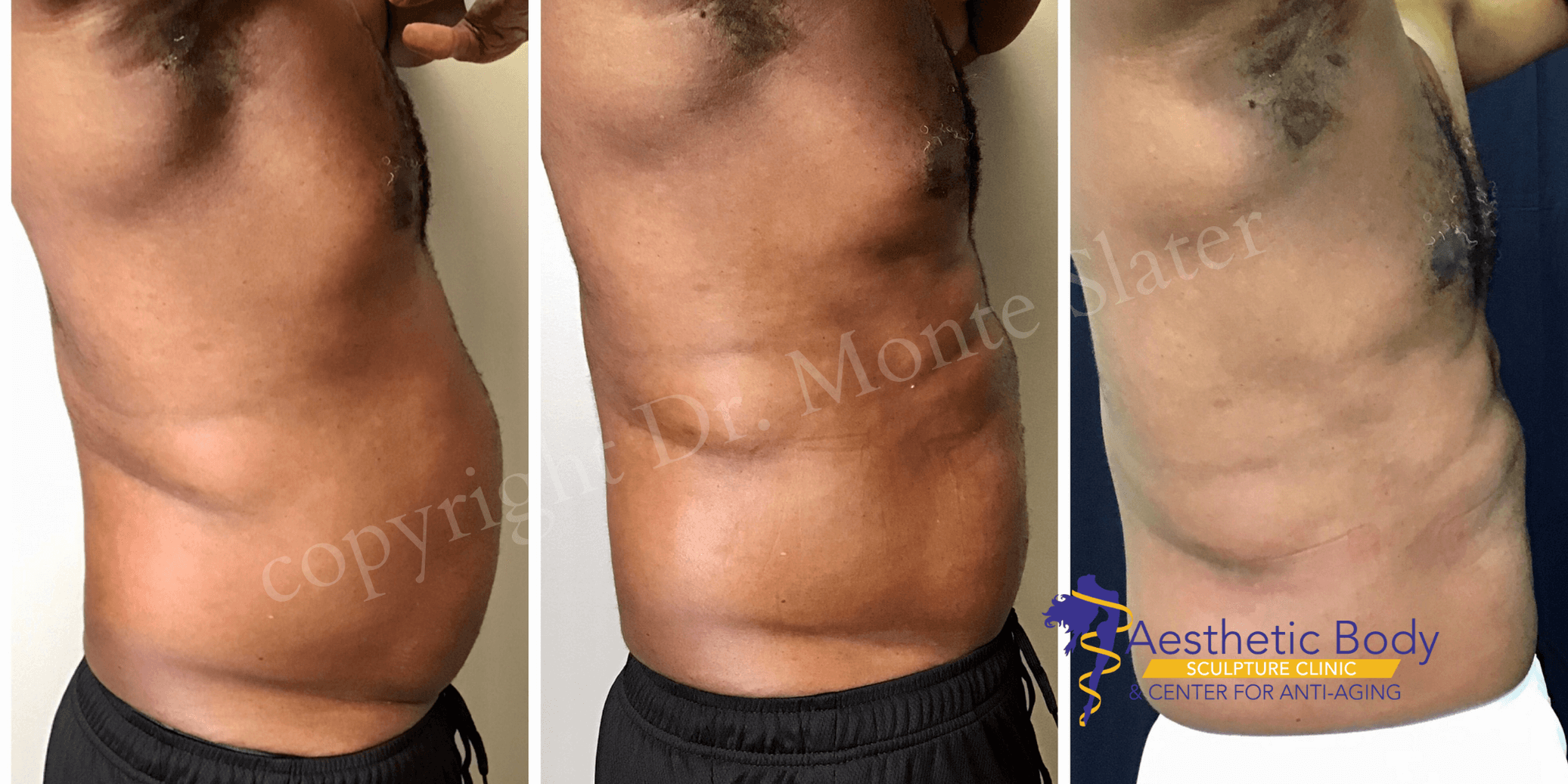 Before and After 2 PHYSIQ Body Contouring Treatments with Dr. Monte Slater