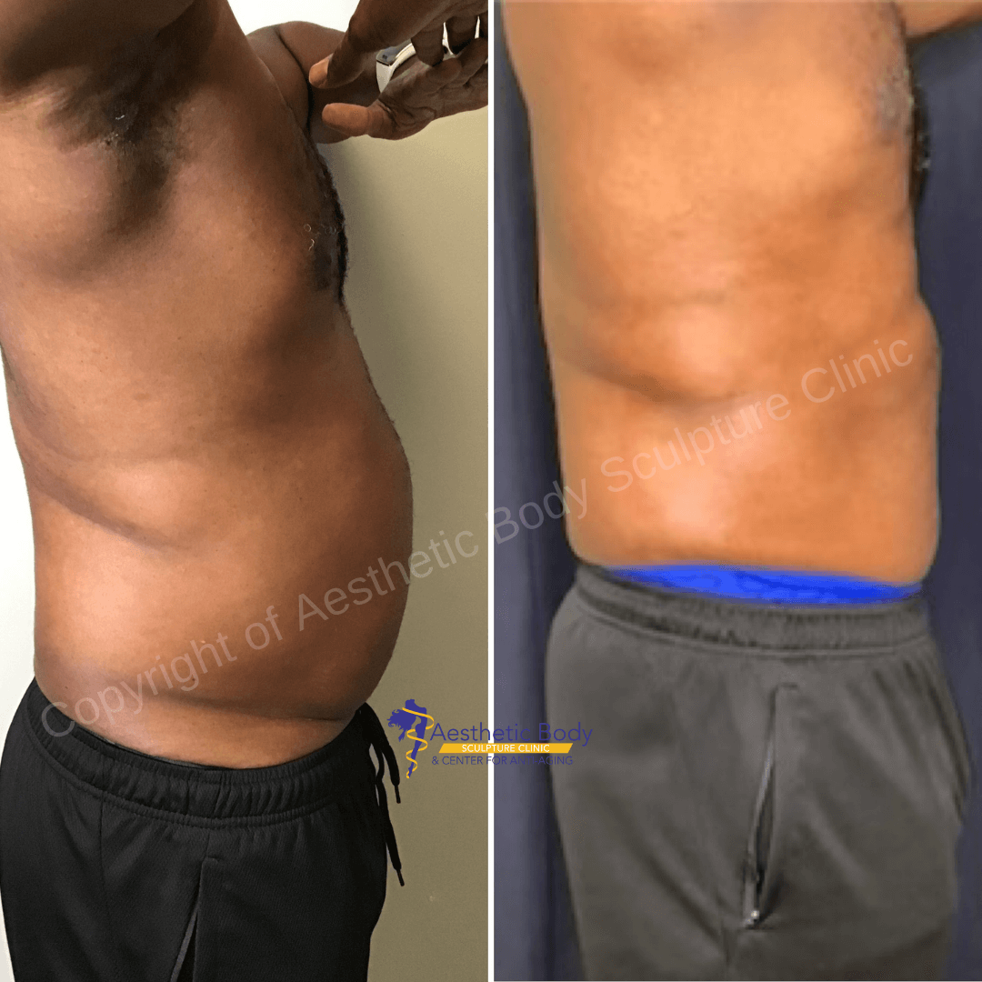 Dr. Slater"s Patient Before and After 5 PHYSIQ Treatments