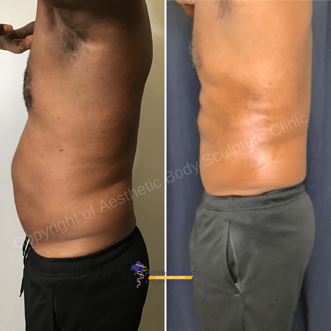 Dr. Slater"s Patient Before and After 5 PHYSIQ Treatments