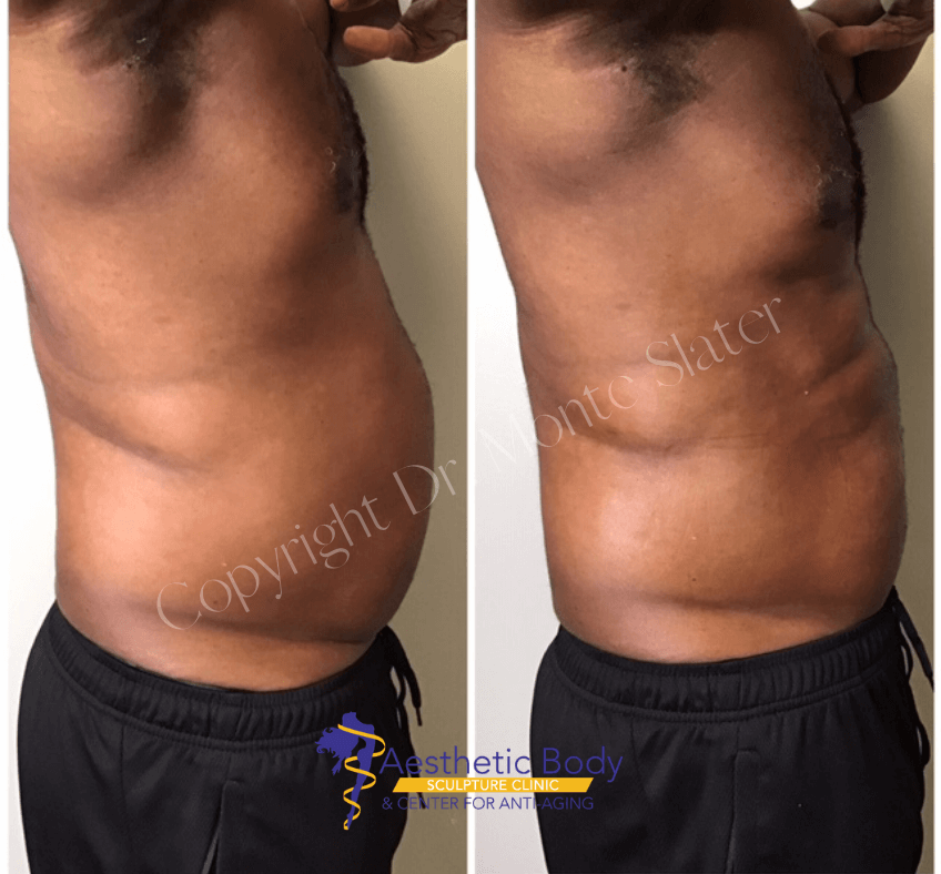 PHYSIQ Before and After - Copyright Dr. Monte Slater