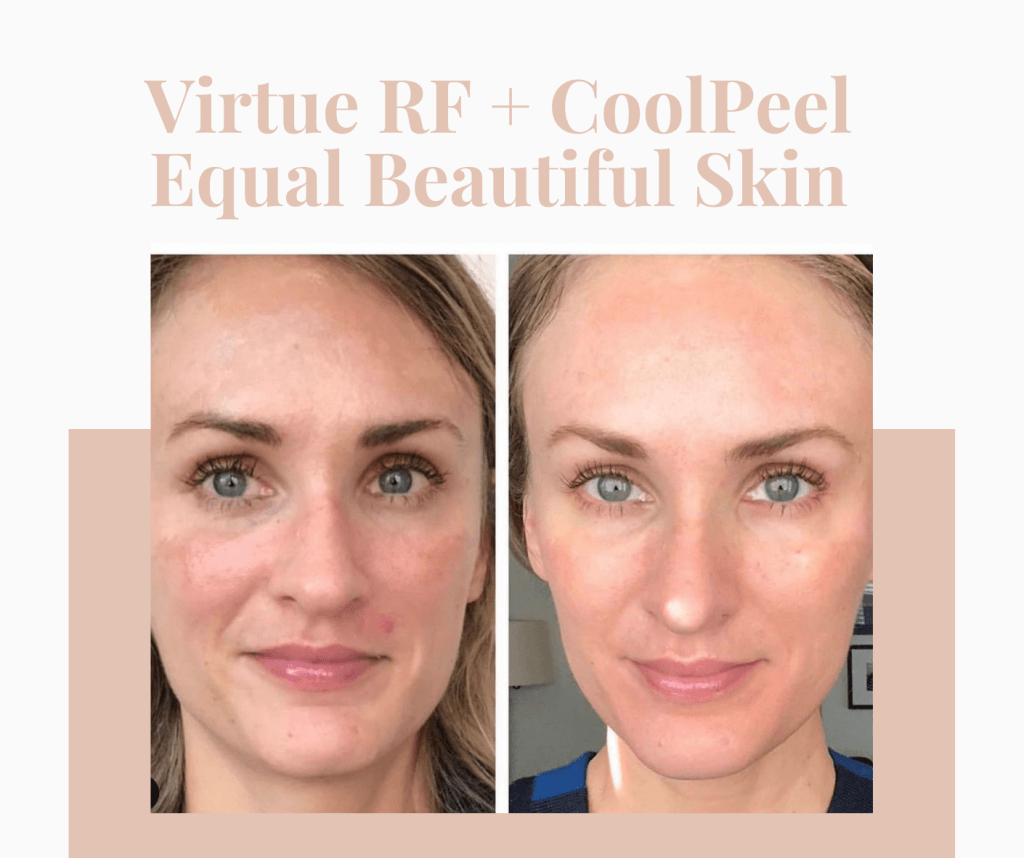 CoolPeel and Virtue RF Facial treatment in Atlanta