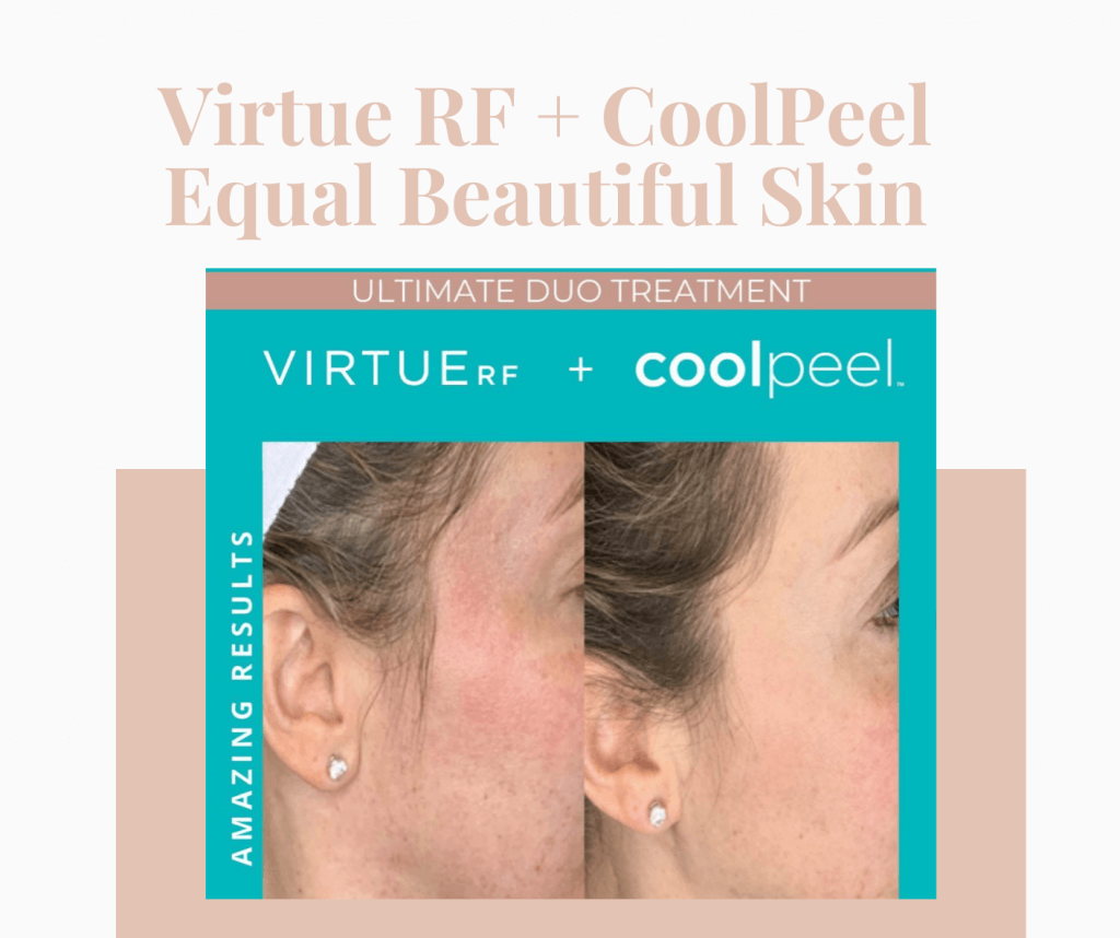 Before and After Coolpeel laser treatments