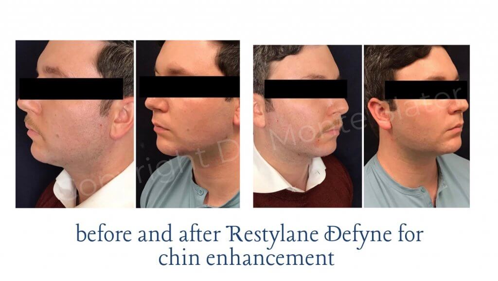 Before and After Restylane Defyne for Chin Enhancement