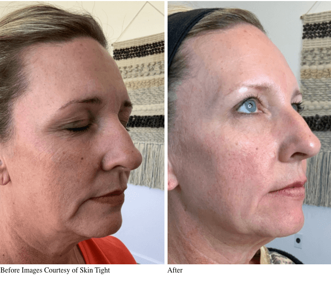 Before and After VirtueRf Microneedling Treatment for Skin Rejuvenation & Skin Tightening