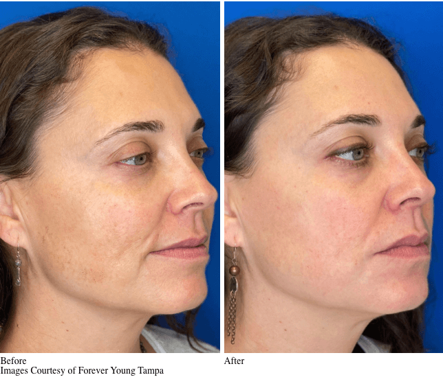 Before and After VirtueRf Microneedling Treatment for Skin Rejuvenation & Skin Tightening