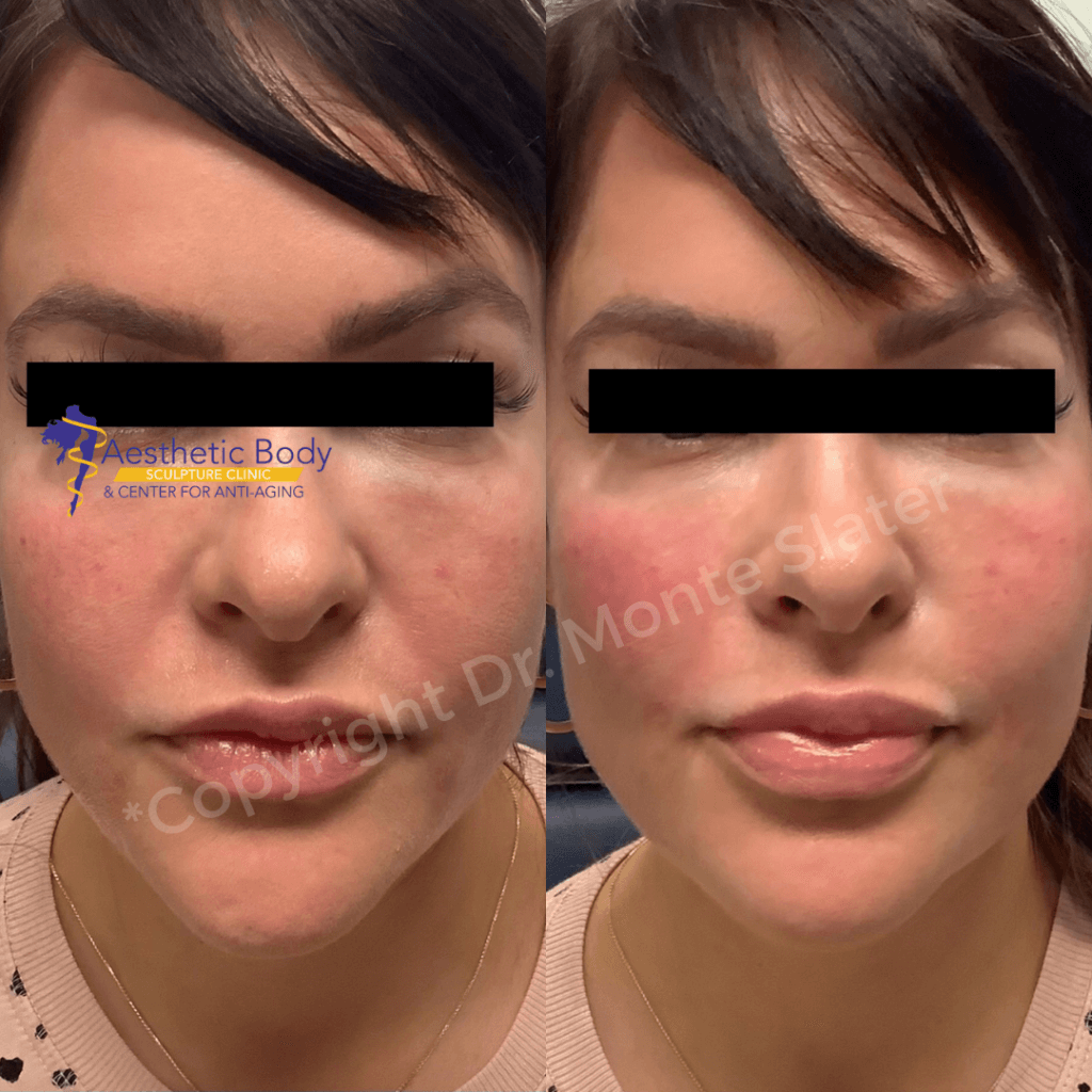 Before and after only one Syringe of Restylane Contour to the cheeks