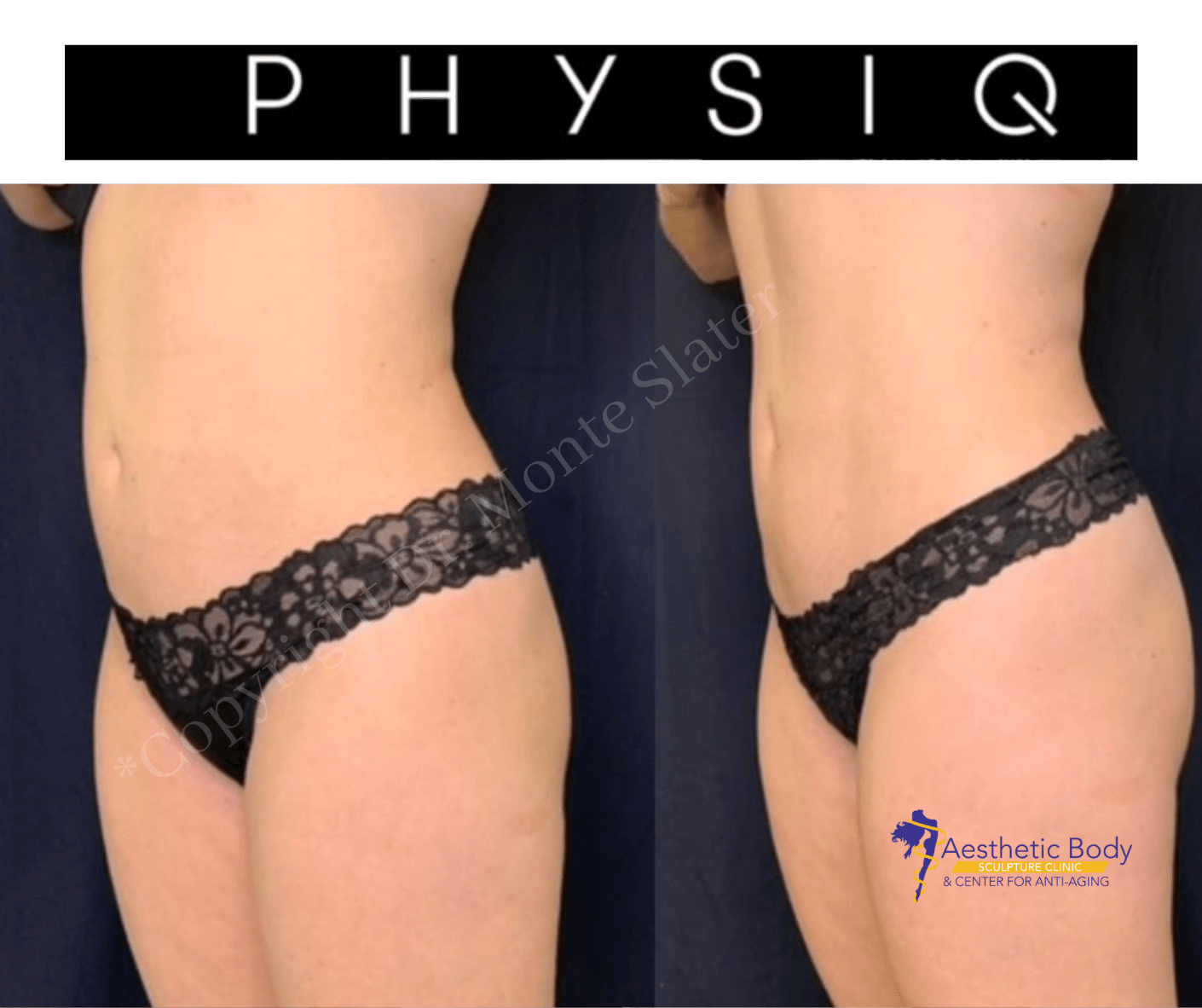 PHYSIQ, No Downtime, Target Fat & Enhance Muscle Tone