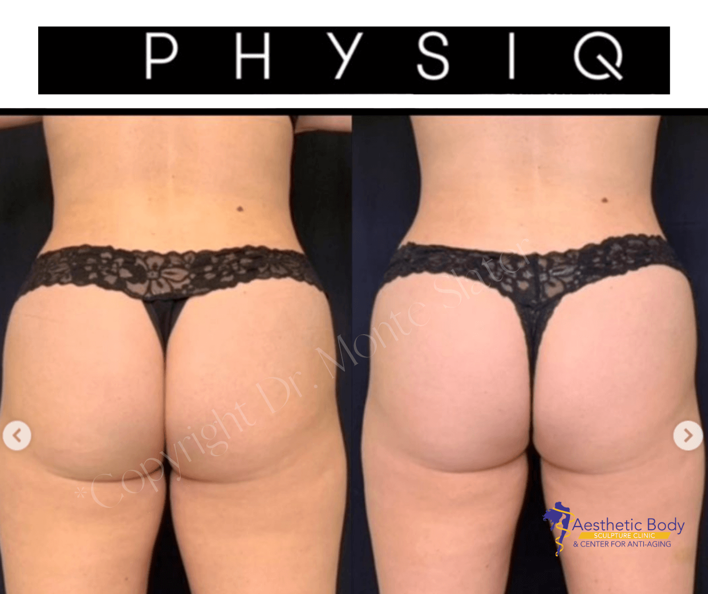 Physiq Body Sculpting  Charette Cosmetics Medical Spa