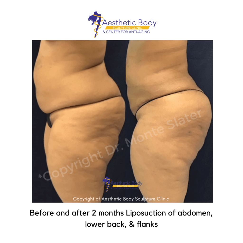 Before and after 2 months Liposuction of abdomen, lower back, & flanks