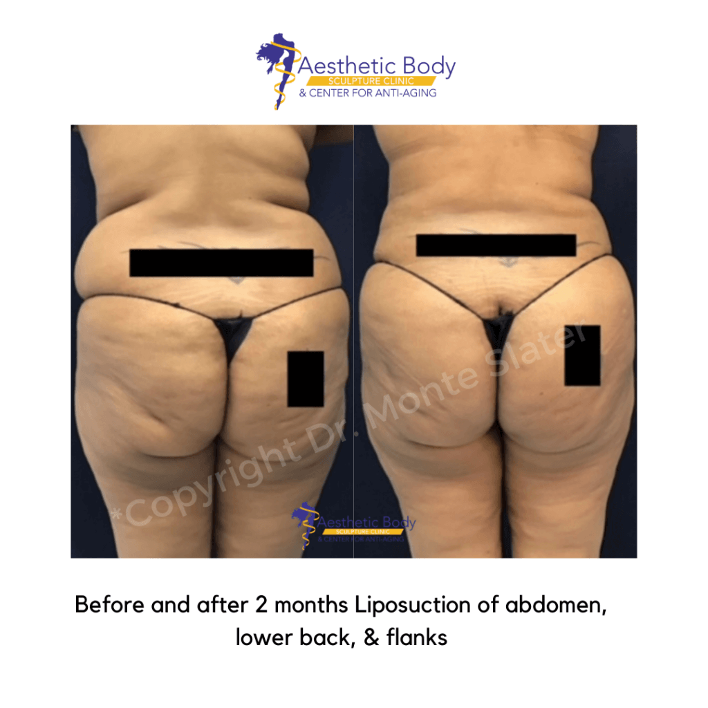 Before and after 2 months Liposuction of abdomen, lower back, & flanks