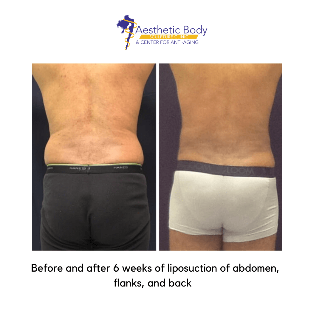 before-and-after-liposuction-of-abs-and-flanks-2 Before and after 6 weeks of liposuction of the abdomen, back, and flanks