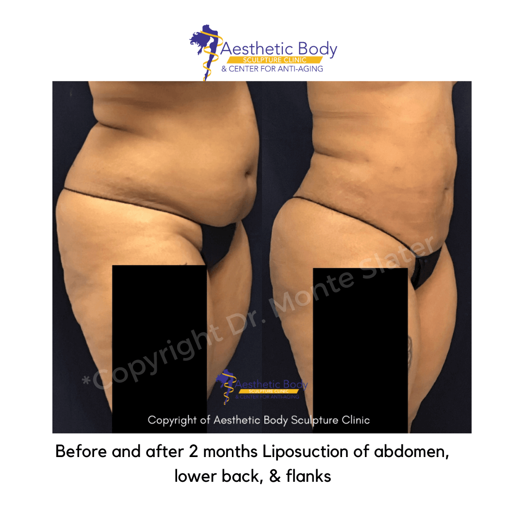Flank Liposuction Before and After - Glow Aesthetic Medicine