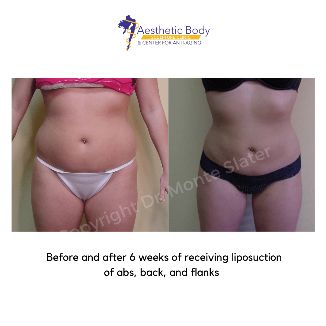 before-and-after-only-one-syringe-of-restylane-contour–to-the-cheeks-3 Before and after liposuction by Dr. Monte Slater 6 weeks post op - abs flanks and back