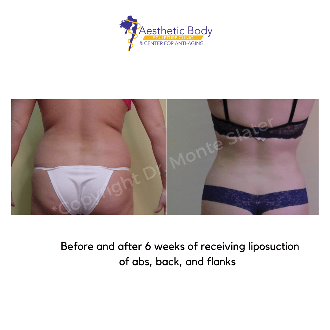 Before and after liposuction by Dr. Monte Slater 6 weeks post op - abs flanks and back