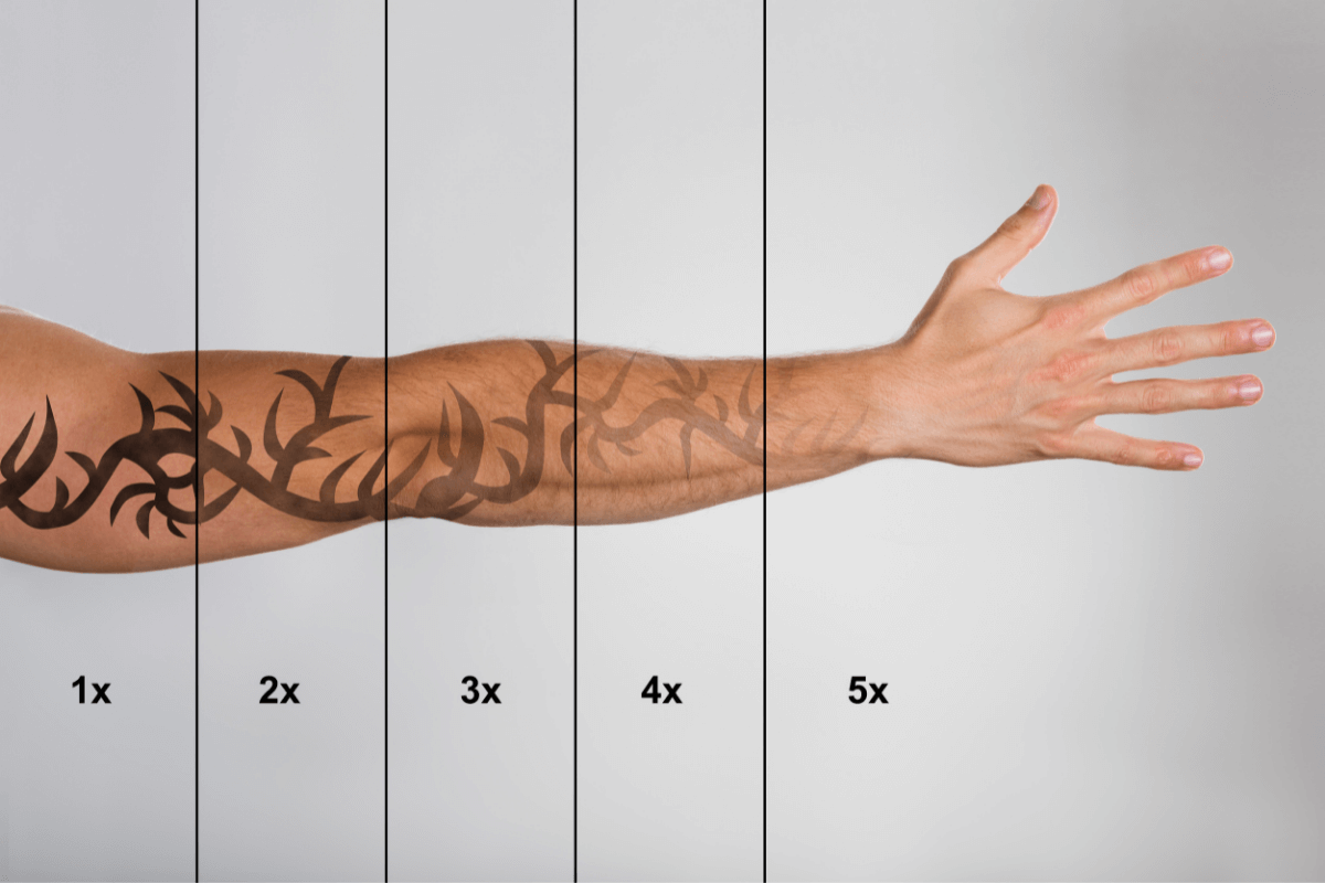 Unwanted tattoos fade away with Discovery Pico Tattoo Removal in Atlanta