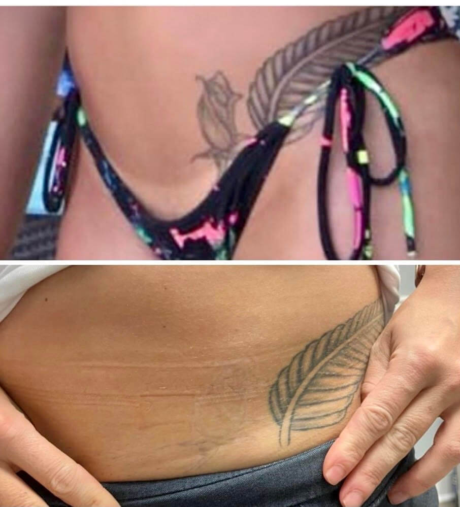 Laser Tattoo Removal Before After Photos Atlanta Georgia  Roswell   Marietta