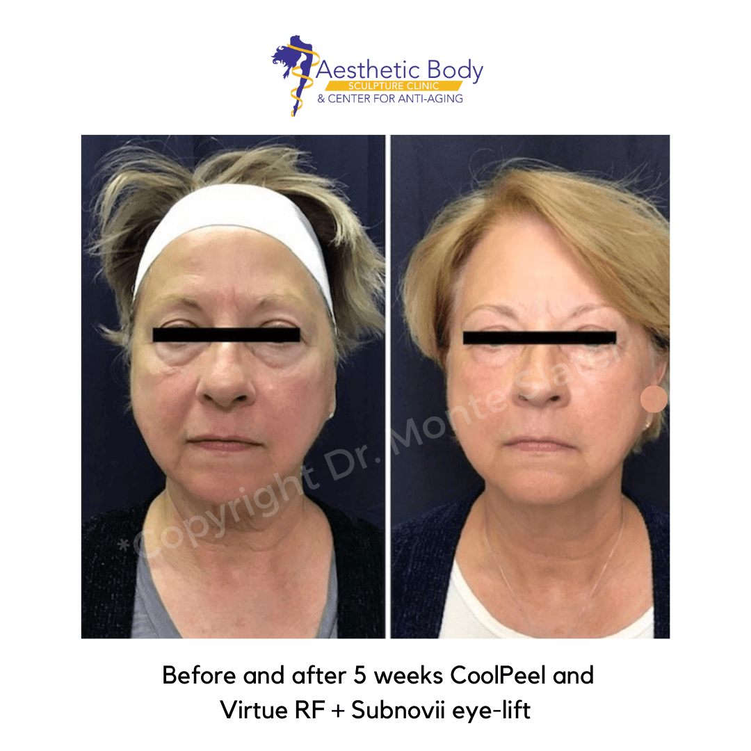 Before and after 5 weeks CoolPeel and Virtue RF + Subnovii eye-lift - Slater Aesthetic Before and Afters