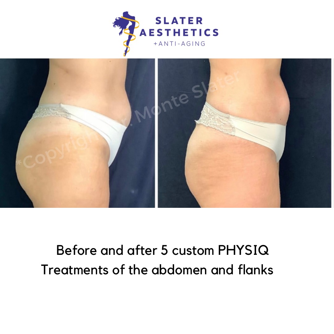 Before and after 5 custom treatments with PHYSIQ Areas treated abs and flanks