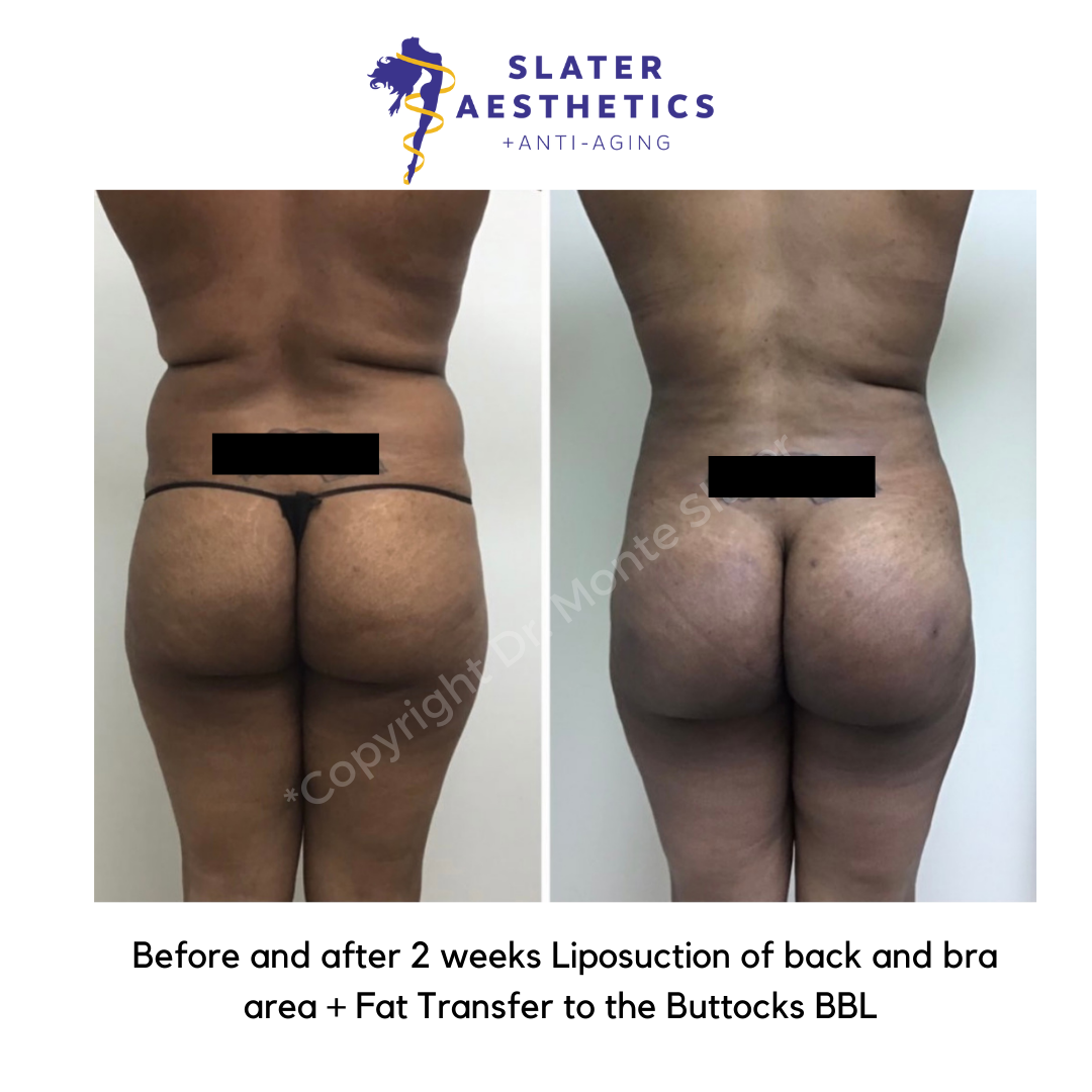 Before and after 2 weeks of receiving Liposuction of flanks, abs, low-back and bra area, with fat transfer to the buttocks - BBL Brazilian Butt Lift by Dr. Monte Slater