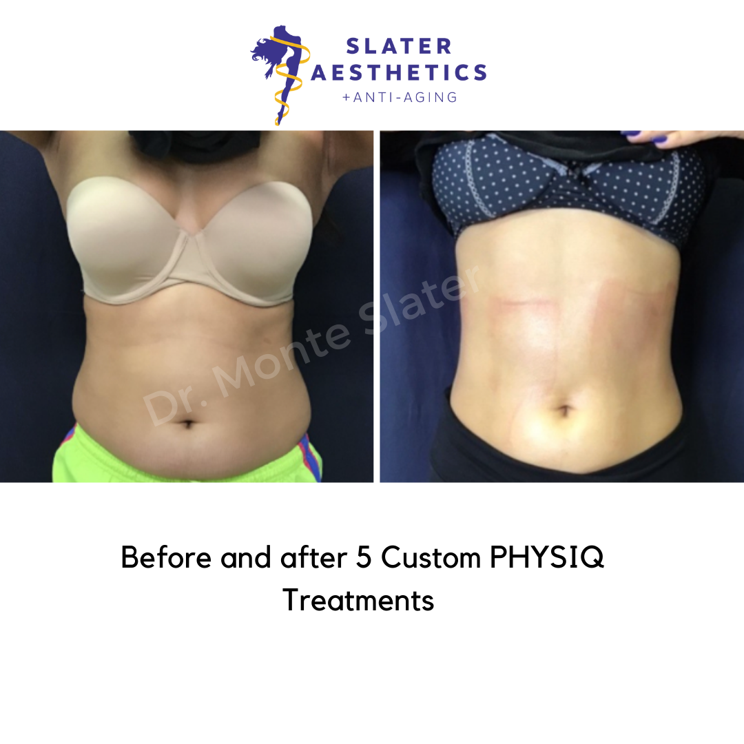 Before and after PHYSIQ front view 5 treatments