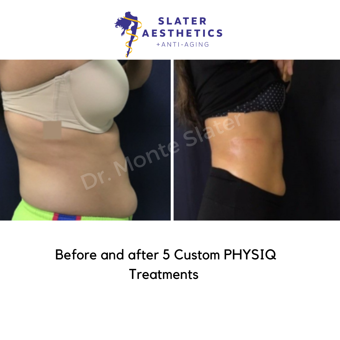 Before and after PHYSIQ side view 5 treatments