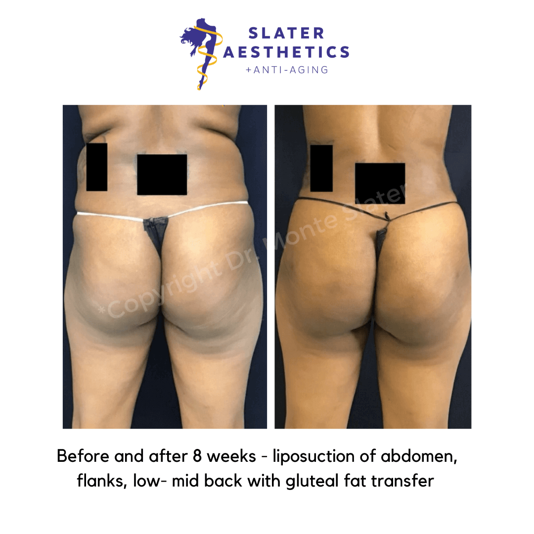Before and after 8 weeks of receiving liposuction of abdomen, flanks, low-mid-back with fat transfer to the buttocks - BBL - Brazilian Butt Lift
